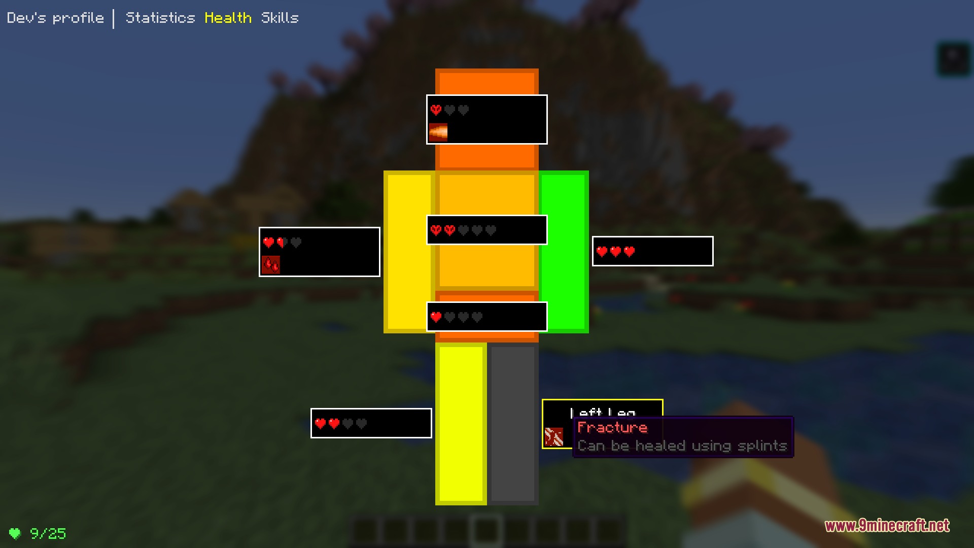 Medical System Mod Screenshot 1 Minecraft character health interface displaying individual limb health and a bone fracture status